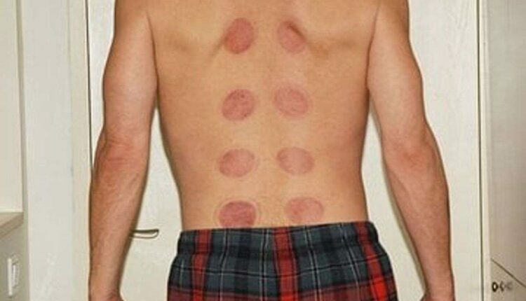 acupuncture for back pain
