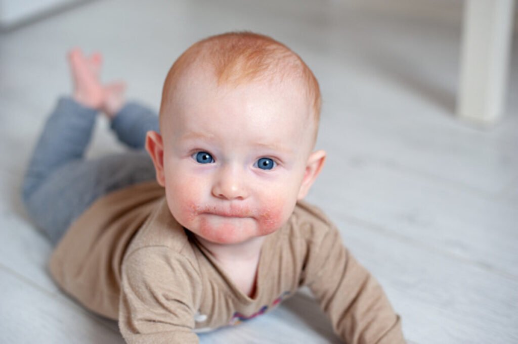 Therapy For Atopic Dermatitis