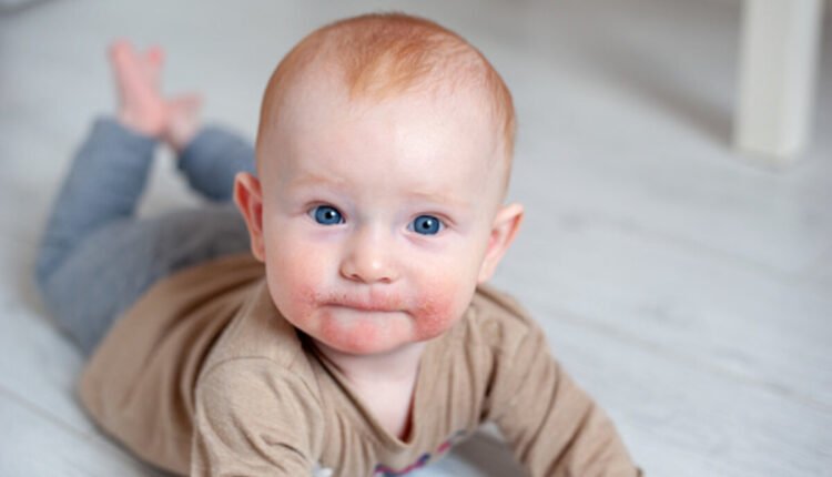 atopic dermatitis