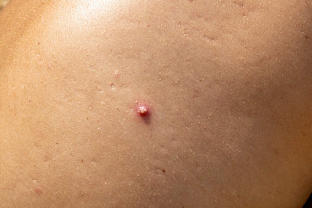 Signs of Hidradenitis Suppurativa