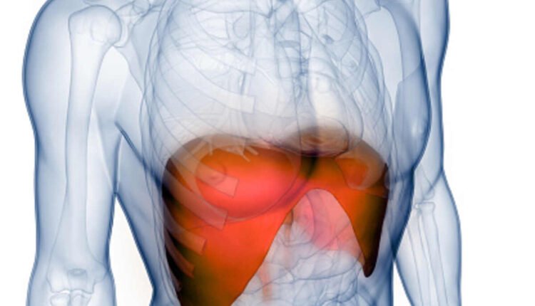 sarcoidosis